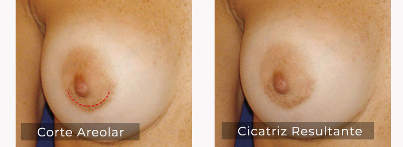 Corte Areolar como vía de abordaje en el implante mamario